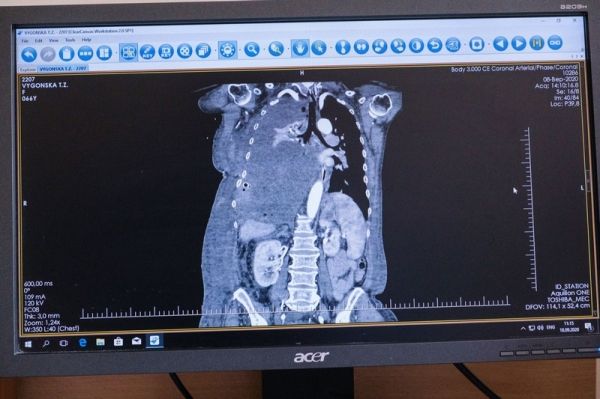 Украинские медики удалили опухоль весом в 4,5 кг