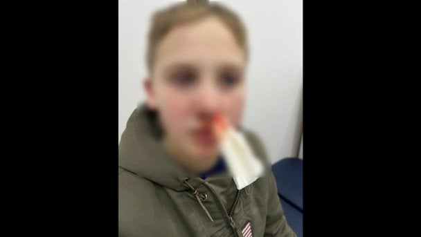 Для визначення ступеня тяжкості ушкоджень дитині призначено судово-медичну експертизу.